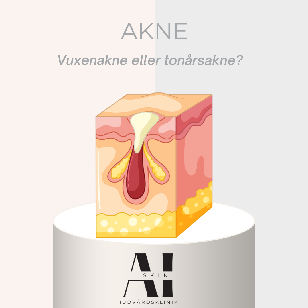 Akne hos vuxna och tonåringar