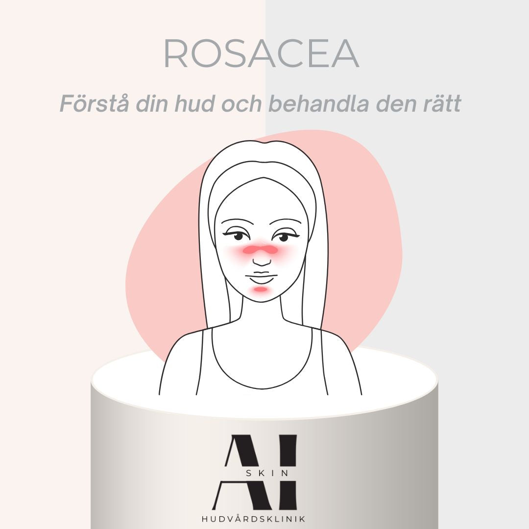 Allt om Rosacea och hur du ska ta hand om din hud