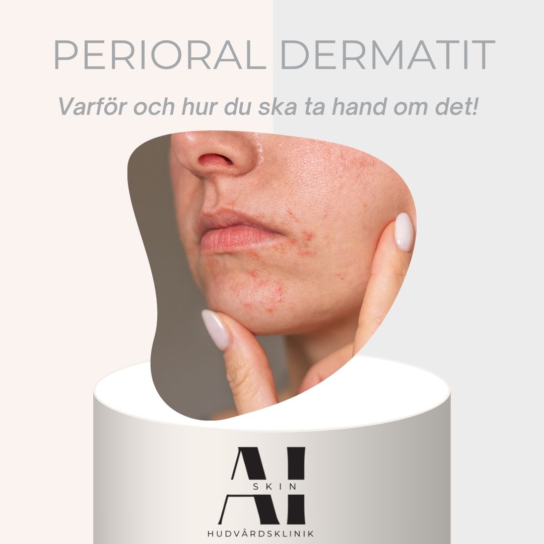 perioral dermatit, varför och hur du behandlar det. Tips på produkter för PD