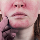 Kärl, rodnad & rosacea
